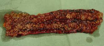 Check spelling or type a new query. Reflexions La Maladie De Crohn