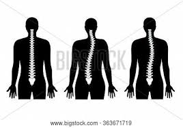 The human back extends from the buttocks to the posterior portion of the neck and shoulders.it is opposite from the chest, and the vertebral column runs down the back. Scoliosis Flat Vector Vector Photo Free Trial Bigstock