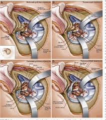 We studied the additional exposure provided by skeletonizing the sigmoid sinus (ss). Posterior Transpetrosal Approach Less Is More Semantic Scholar