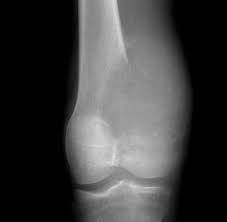Image result for Osteosarcoma
