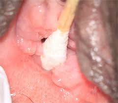 The hymen is a very delicate membrane and can be torn quite easily. Interpretation Of Medical Findings In Suspected Child Sexual Abuse An Update For 2018 Sciencedirect