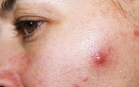 Image result for skin cancer on nose pimple