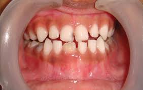 Image result for Dentition