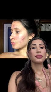 Soap for Face Acne from Mexico