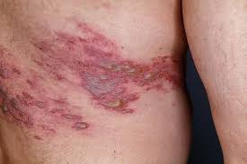 Image result for shingles
