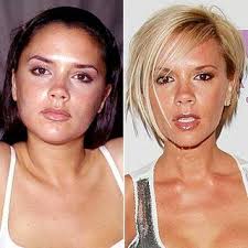 Victoria Beckham Before And After Plastic Surgery Dorothy Johnson Perder Peso Perda De Peso Antes Cirurgia Plastica