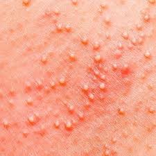 Image result for Keratosis pilaris