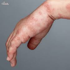 Image result for scabies human bites