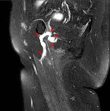 Image result for Obturator Nerve Compression