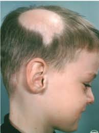 For the majority of children 26 months or older suffering hair loss, one of the following conditions is the cause. Alopecia Areata Dermatologist In Belleville Nj