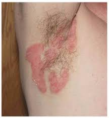 Se você sofre com a psoríase, este assunto é para você. Psoriase Invertido Fotos