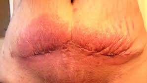 Which is best for you? Itchy Red Reaction To Steri Strip Adhesive After Lipo To The Abdomen Possible Allergic Reaction Photo