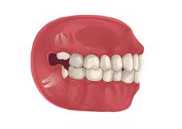 Here you may to know how to smoke without getting dry socket. Wisdom Teeth Removal Cost Pain And Recovery Authority Dental