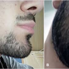 This is a process that takes several years for hair on the head but a few months for facial hair that grows on the face. Face Right Aspect A Pre Treatment B After 3 Months Of Topical Download Scientific Diagram