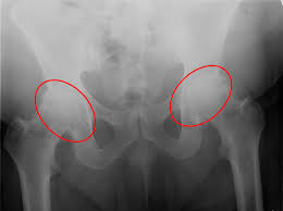 Image result for Hip XRay