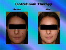 Their mechanism of action, effectiveness, and safety. Resnik Skin Institute Aventura Florida Barry I Resnik Md Treatment With Isotretinoin For Severe Or Unresponsive Acne