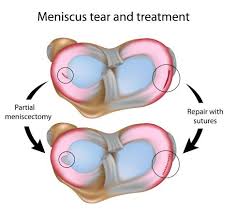 Many surgeons differ in their preference and depending on. Meniscus Tear Surgery Rehabilitation Costs Joint Surgeon Com