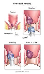 Image result for Hemorrhoid