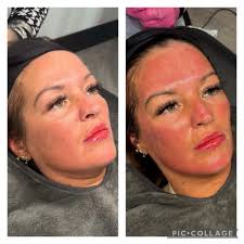 Get yours every 4 weeks to keep that skin glowing for just £25 ❤️ Block  booking 3 sessions for £65 saving £10 💪🏽