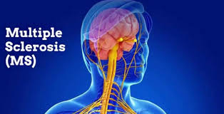 Multiple Sclerosis Causes, Pathogenesis, Sunlight, Melatonin, Stem Cells,  Costa Rica