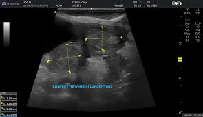 Image result for Retained Placenta