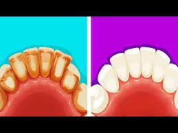 You should use a soft toothbrush that you replace at least every three to four months,. 8 Effective Ways To Remove Plaque In Five Minutes Colorado