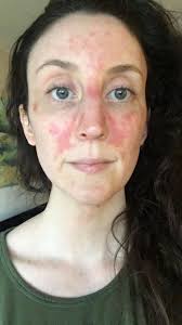 Efudex and carac are the names of a topical chemotherapy cream commonly used for skin cancers and precancerous lesions. With Summer Just Around The Corner I Thought I D Share This As A Psa Always Wear Sunscreen Not Just When You Re Swimming Topical Chemo Is Extremely Effective For Precancer And Early Skin
