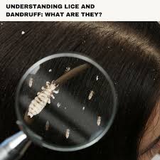Image result for lice vs dandruff