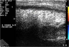 Check spelling or type a new query. Multicenter Surgical Outcomes Of Penile Prosthesis Placement In Patients With Corporal Fibrosis And Review Of The Literature International Journal Of Impotence Research
