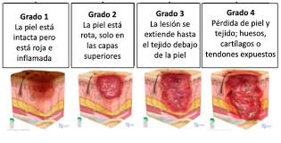 Patient Education - Pressure Ulcers/ Injuries (Spanish)