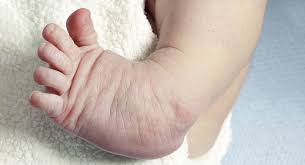 Babies treated using the ponseti method will have normal looking feet, with good mobility. Talipes Babycentre Uk