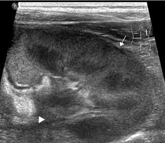 About 20% of these are medical ultrasound a wide variety of ultrasound baby options are available to you, such as shelf life, material, and warranty. Ultrasound Of The Paediatric Urogenital Tract European Journal Of Radiology