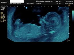 Consultas médicas y ecografía gestacional. Ecografia Hd 5d Diagnostico Prenatal