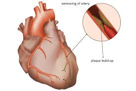 Heart Coronary Artery Disease Atherosclerosis Mount Elizabeth Hospitals
