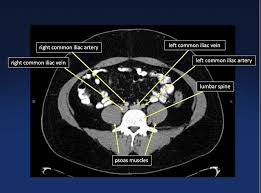 Ct abdomen ct pelvis / 5. Elliot K Fishman Ctisus Com On Twitter Ct Pelvic Anatomy Medtwitter Radiology Radres