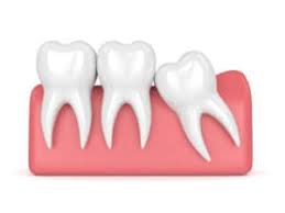 Wisdom teeth extractions are often covered by insurers. What Happens If You Don T Get Your Wisdom Teeth Removed