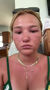 Swelling in Feet and Legs from Sunburn