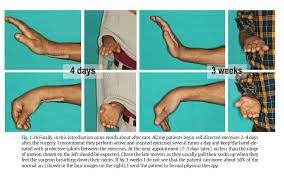 Try not to get discouraged, because the swelling will most likely improve with time. Five Worrying Signs After Surgery On A Wrist Fracture