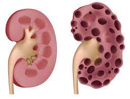 Acute renal failure after heart transplantation and cyclosporine therapy. Kidney Disease Australia Pdf Ppt Case Reports Symptoms Treatment