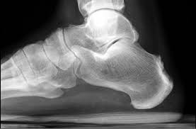 Check spelling or type a new query. Reiter Syndrome Radiology Case Radiopaedia Org