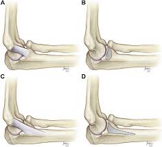 A ligament serves as a tether between the bones. Anatomy Of The Anterior Bundle Of The Medial Ucl Of The Elbow Download Scientific Diagram