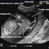 Baby hiccups in the womb can be overwhelming. 1