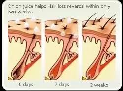 Onion and garlic for hair growth prove to be one of the best blends to give a range of benefits. Has Anyone Had Any Success Using Onion Juice To Regrow Their Hair Quora