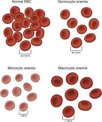 Jumlah sel darah merah menurun pada pasien anemia leukemia, penurunan fungsi ginjal, talasemia dan lupus eritematosus. Gejala Diagnosis Dan Rawatan Anemia