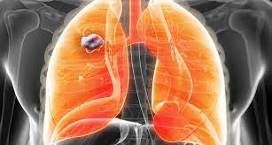 Nicht Kleinzelliges Lungenkarzinom Limitierte Chemotherapie