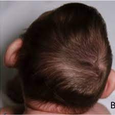 Hair swirls are easy to use and elegant to wear. Several Infants Had Abnormal Hair Patterns Such As Double Hair Whorls Download Scientific Diagram