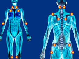 Solfa syllable fibromialgia es una enfermedad reumática, que abarca una constelación de síntomas que pueden. Arquivos Sintomas Fibromialgia Sociedade Mineira De Reumatologia