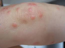 Can i get a disease or illness for a bed bug bite? Red Bed Bug Bites On Elbow Green Valley Pest Control Lawn Care