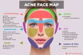 Acne Areas On Face Get Rid Of Wiring Diagram Problem