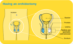 Diagnosing Testicular Cancer Cancer Council Victoria